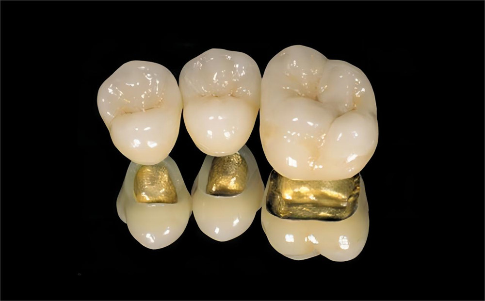 Nobel PFM teeth